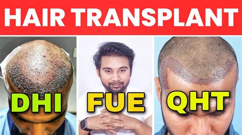 Haartransplantatie Technieken: FUE Vs. DHI
